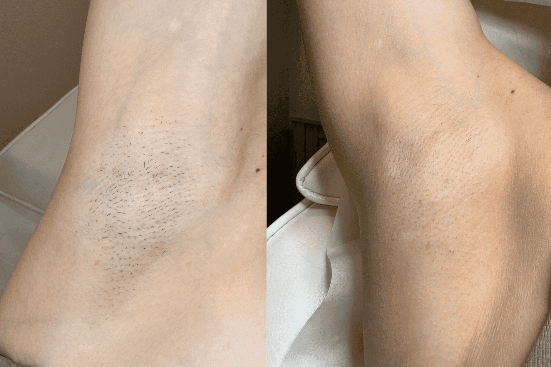Comparison of underarm before and after hair removal, showing smoother skin on the right.