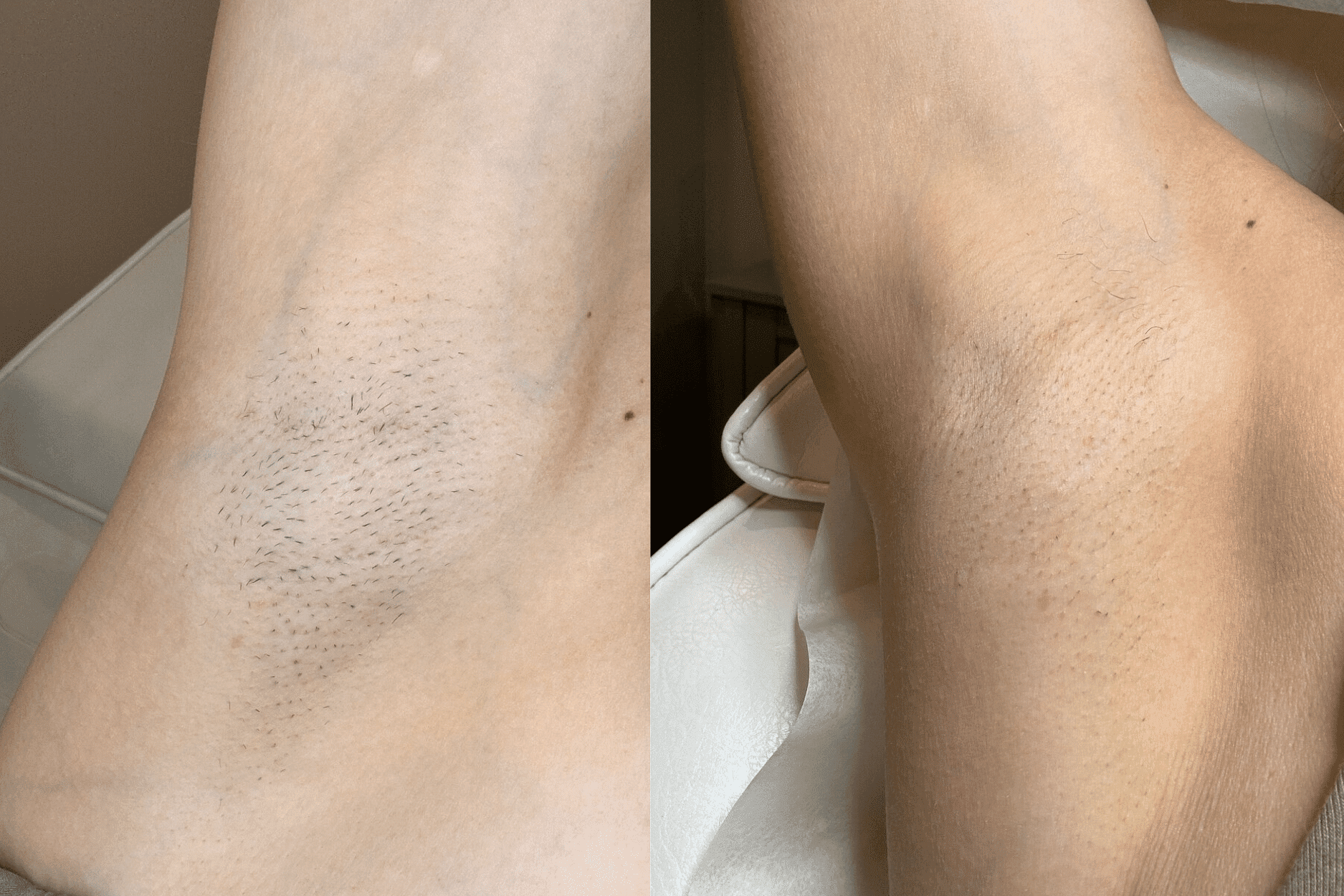 Comparison of underarm before and after hair removal, showing smoother skin on the right.